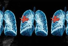 सीओपीडी एवं अस्थमा-वायु प्रदूषण के कारण होने वाली बीमारियों के बीच सीधा संबंध,